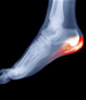Lubbock Heel Pain Center